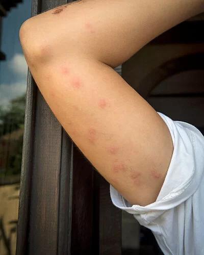 Ujedi stenica — znaci infestacije